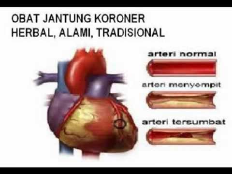 Obat Jantung Koroner Tradisional yang Mudah dan Ampuh