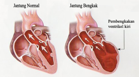 Obat Jantung Bengkak Alami dan Mudah Didapatkan
