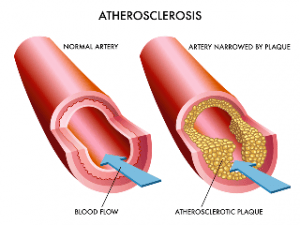 Aterosklerosis