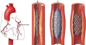 Implantasi Stent