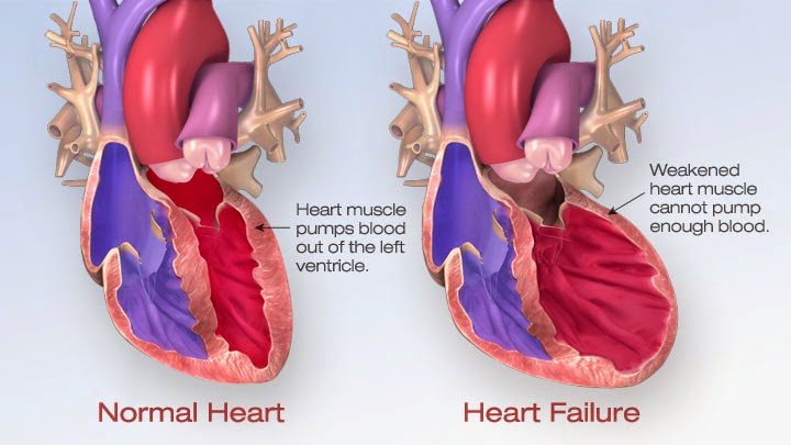 heart failure