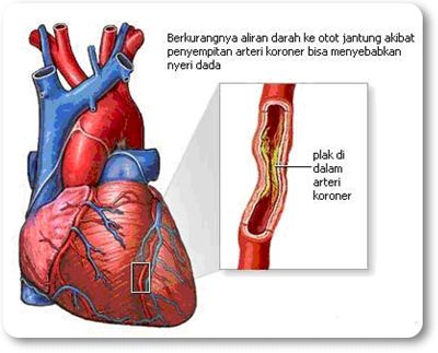 Obat Penyakit Jantung Koroner Terbaik