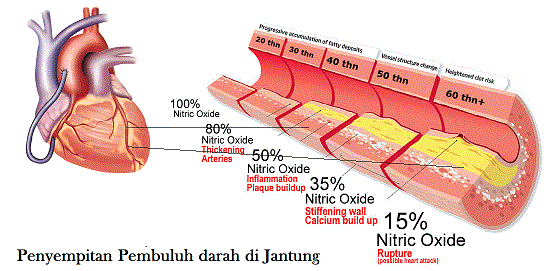 Bagaimana Cara Mengobati Penyempitan Pembuluh Darah Jantung