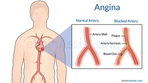 angina