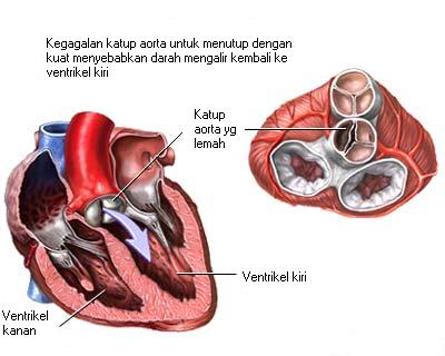 Mengenal Gejala Penyakit Jantung Rematik
