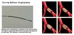Melakukan Angioplasty