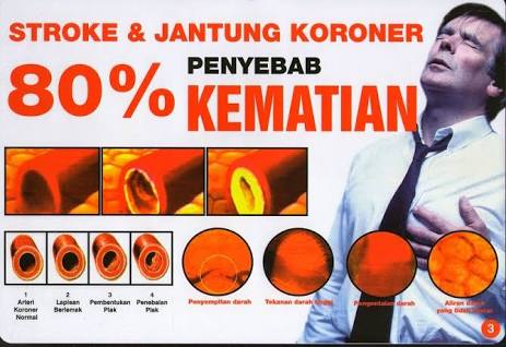28. Gejala penyakit jantung koroner 1