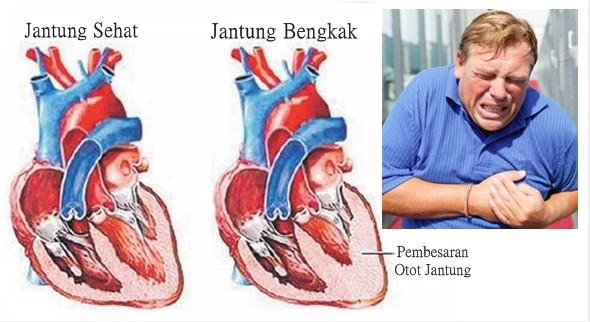 6. cara menyembuhkan penyakit jantung 2