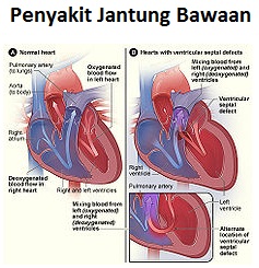 jantung bawaan