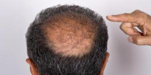 Kebotakan rambut