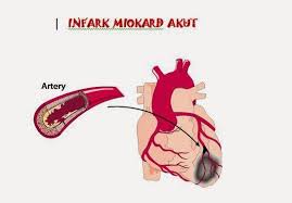 Infark Miokard Akut