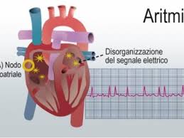 Aritmia