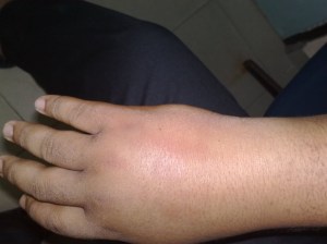 adanya pembengkakan