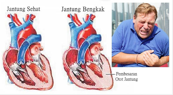 Obat Tradisional Jantung Bengkak Terbaik Menurut Penderita
